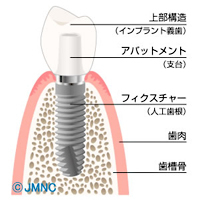 インプラントはどんな治療？